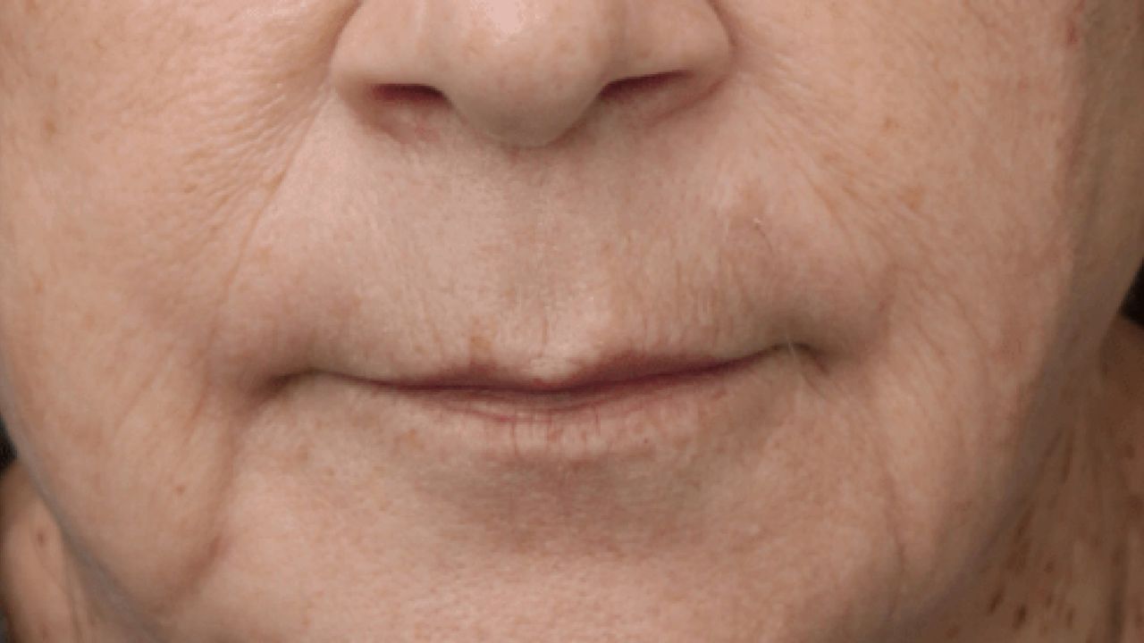 ¿PÉRDIDA DE COLÁGENO O INFECCIÓN OCULTA?